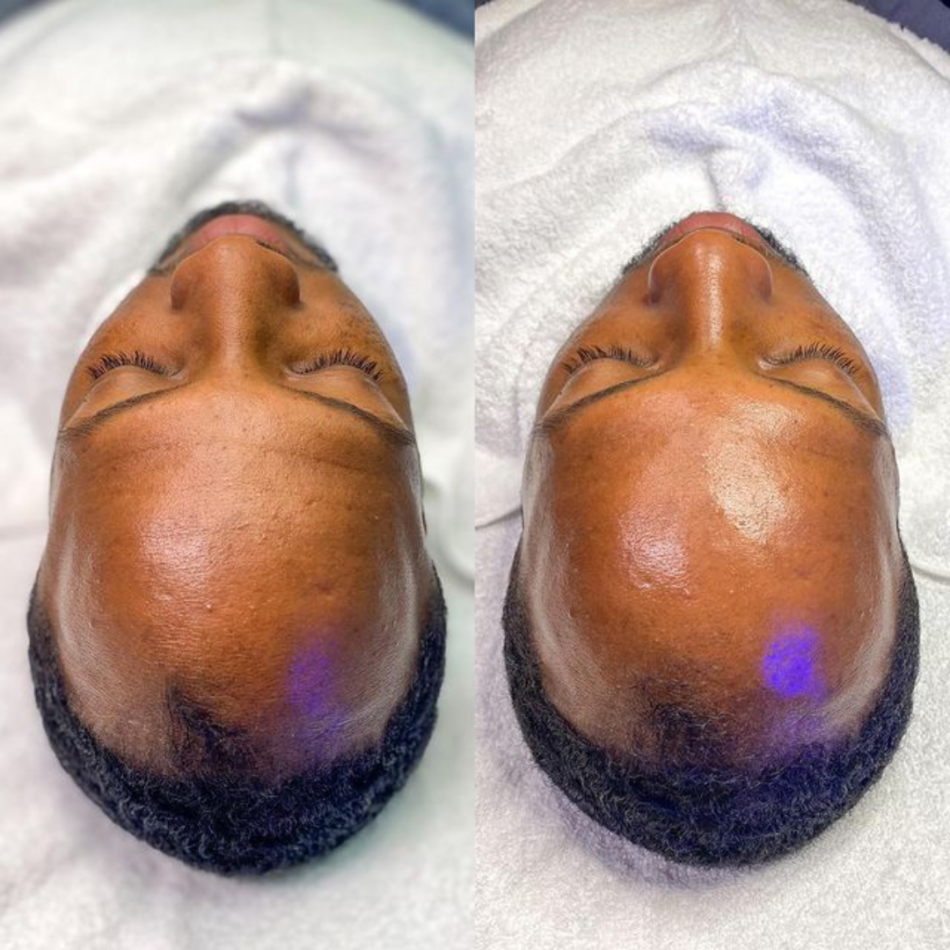 before and after improvement in forehead lines