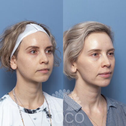 reduction in visible expression lines